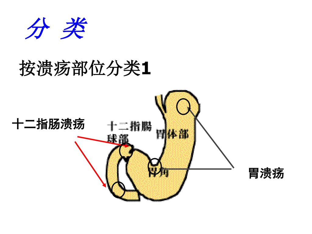 消化性溃疡 peptic ulcer 西安医学院第二附属医院 陈建婷.